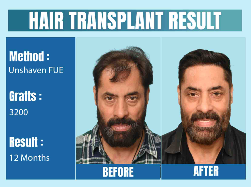 Exploring the Root Cause of Hair Loss in Men: Understanding Causes and Myths